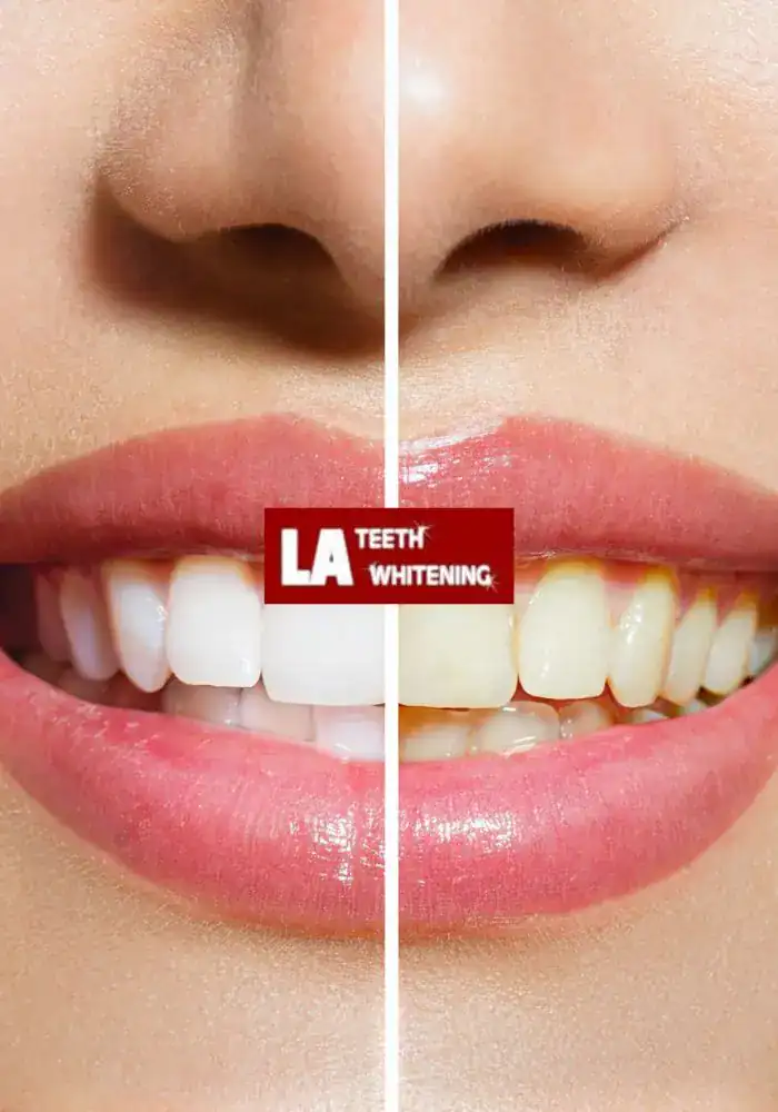 What Should I Expect During a Professional Laser Whitening Session Loughborough