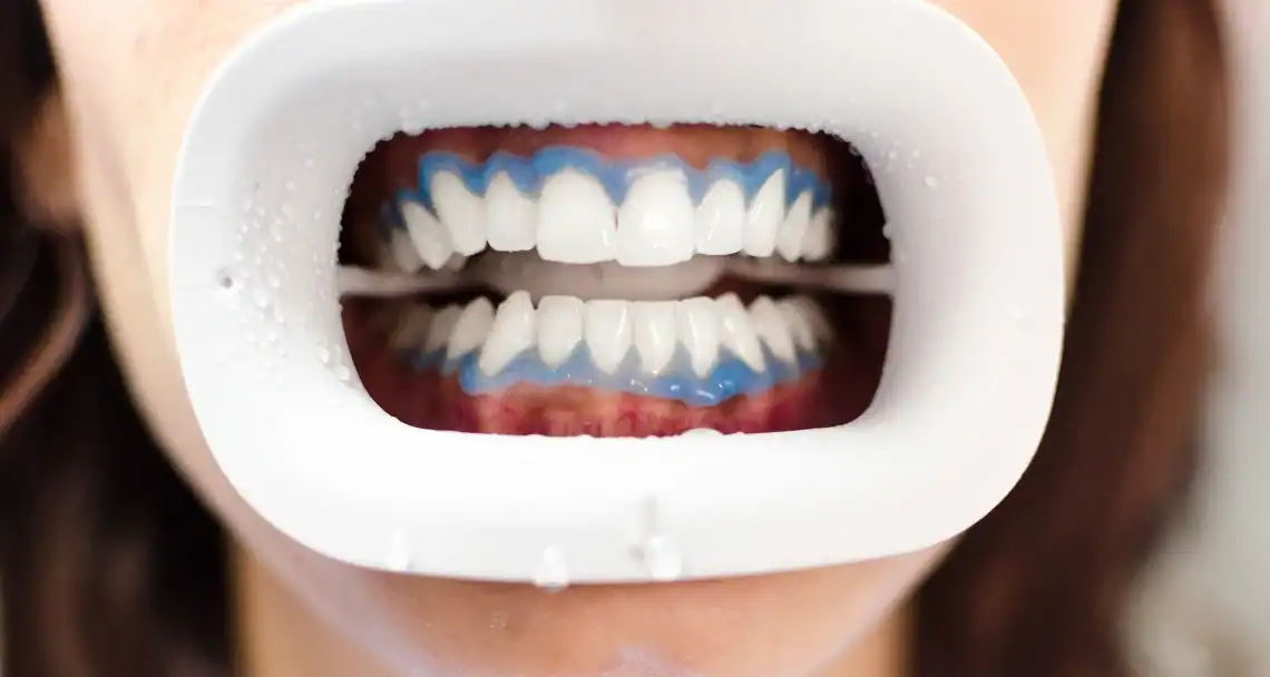 Is Laser Teeth Whitening Safe for Dental Work Loughborough