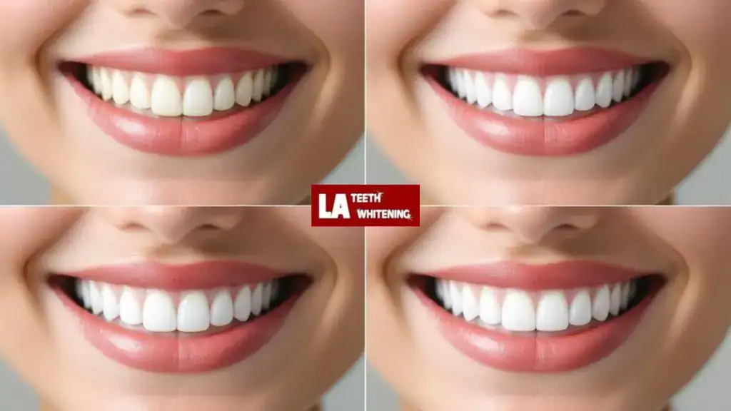 How Can You Keep Your Crowns or Veneers From Staining Over Time Loughborough